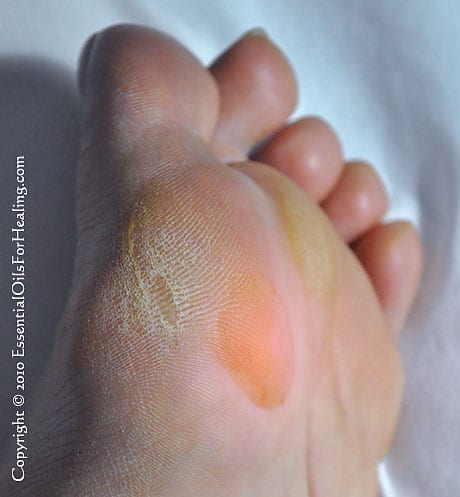 hiking blister on ball of foot