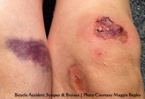 bicycle_fall_scraped_bruised_knees | Copyright © 2013 Maggie Begley